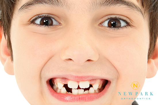 child smiling with crooked teeth