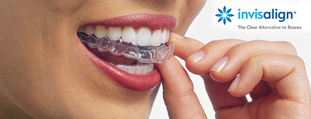 Invisalign Ad