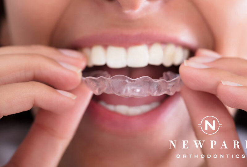 Invisalign Aligners - Newpark Orthodontics