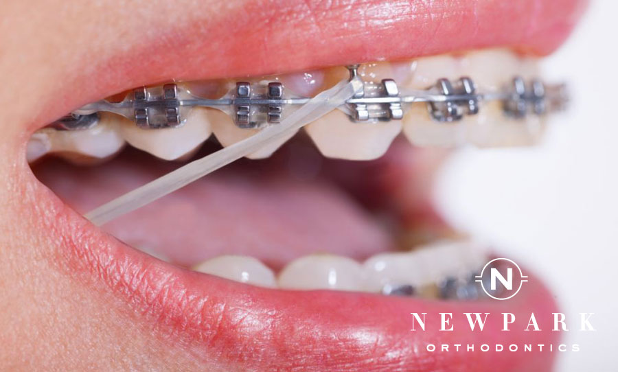 overbite correction rubber bands