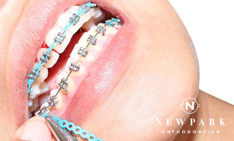 Orthodontic Treatment Options