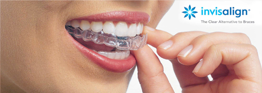 Invisalign Treatment in Alpharetta & Roswell