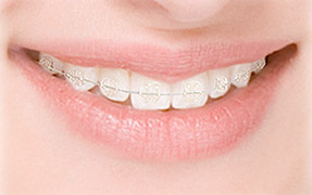 Ceramic Braces Alpharetta