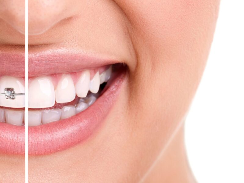 A Smile with half braces in Alpharetta