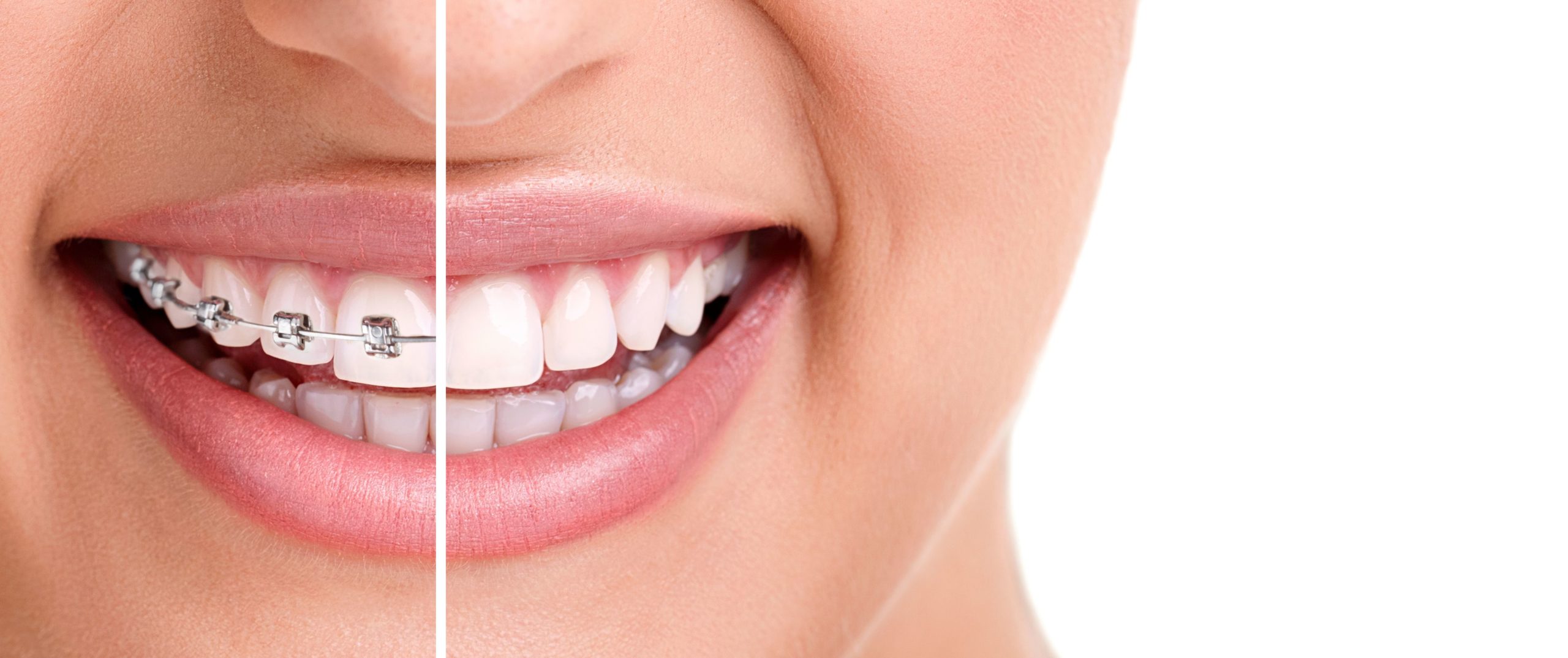 A Smile with half braces in Alpharetta