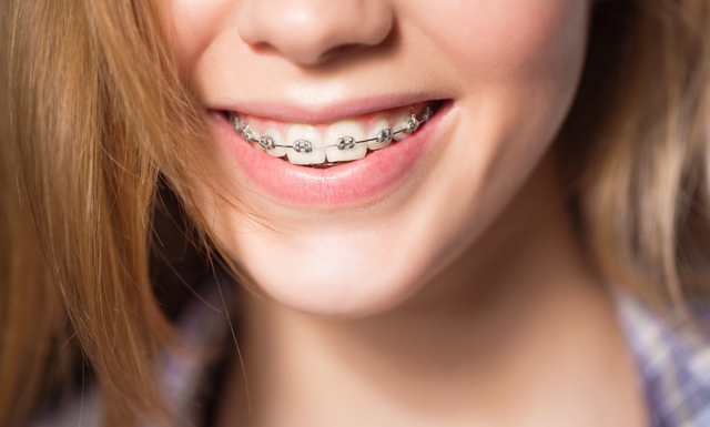 All about Braces in Alpharetta - NewPark Orthodontics