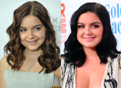 Ariel Winter - Invisalign Treatment Johns Creek