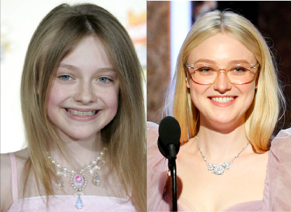 Dakota Fanning - Braces Treatment