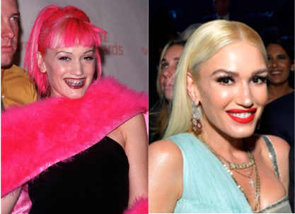 Gwen Stefani - Invisalign Treatment