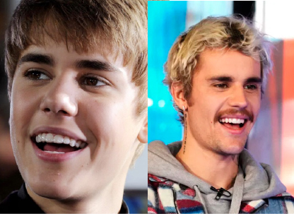 Justin Bieber Invisalign Treatment