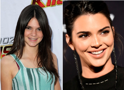 Kendall Jenner - Invisalign treatment