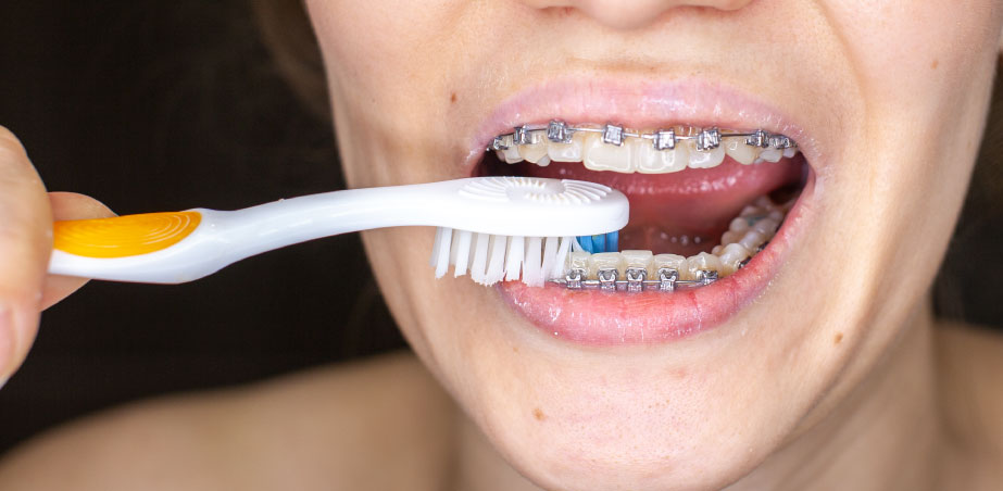 Brushing with braces