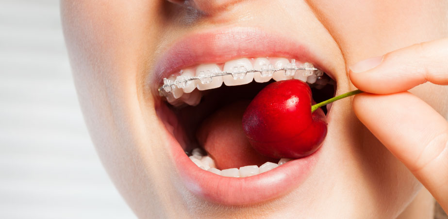 What to Eat With Braces in Alpharetta