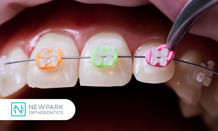 How to Choose Your Rubber Band Colors - Newpark Orthodontics