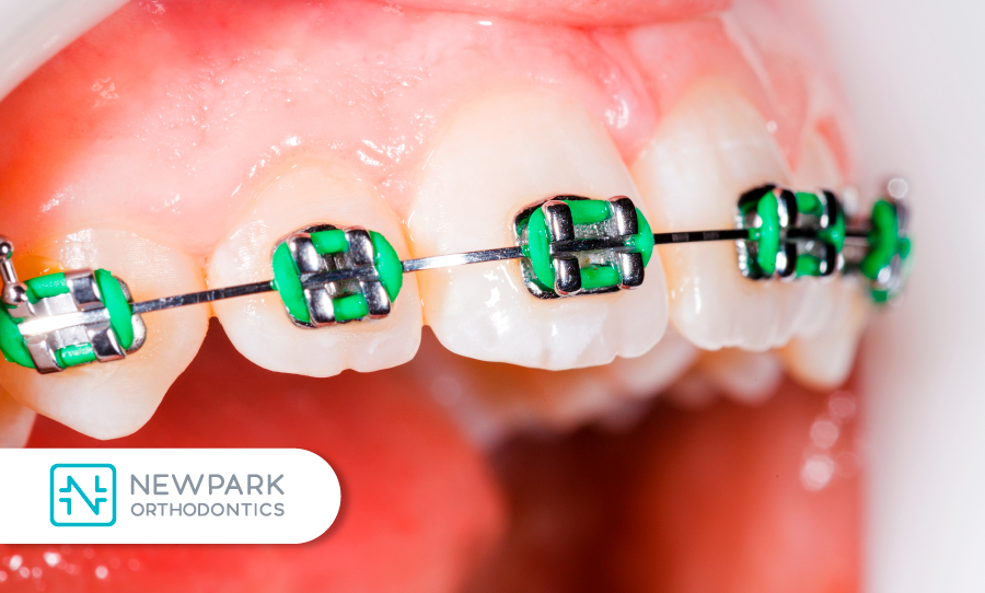 Ceramic Braces: Ancient Origins, Bright Future! - Sunbury Dental House