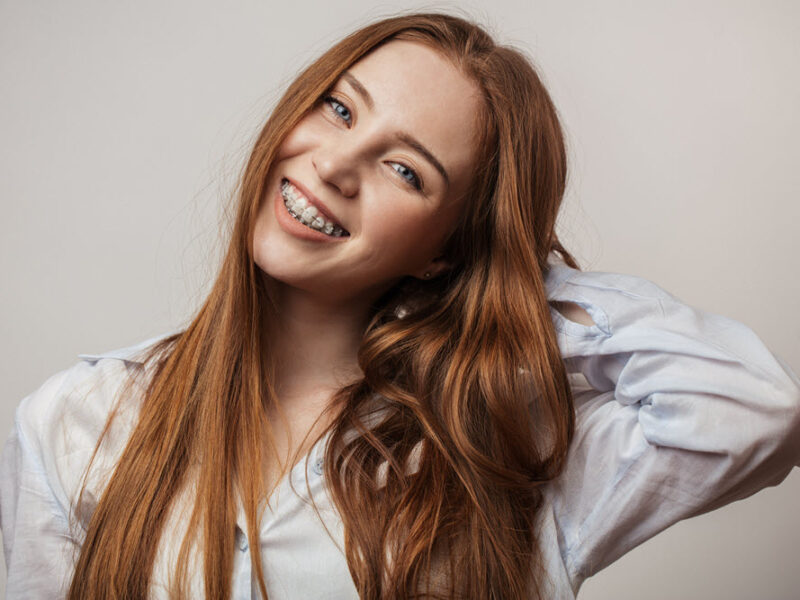 clear braces vs metal braces