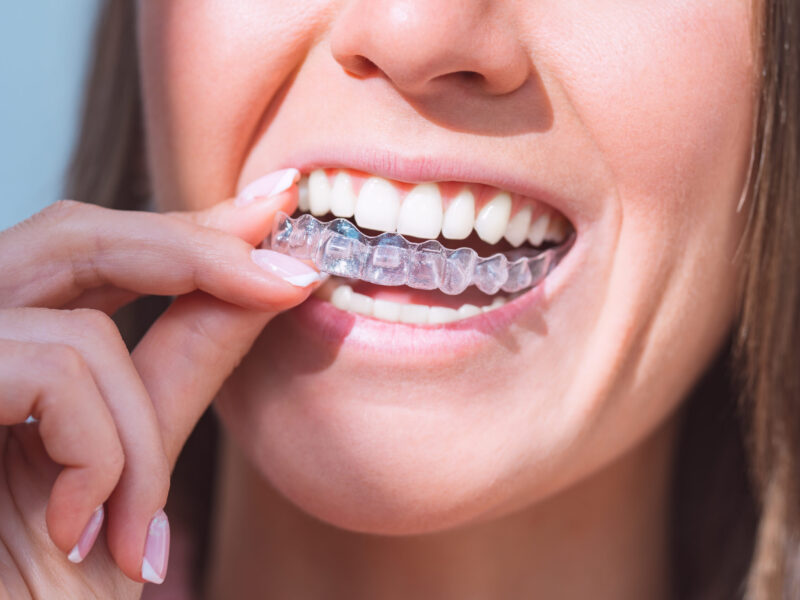 retainers after braces