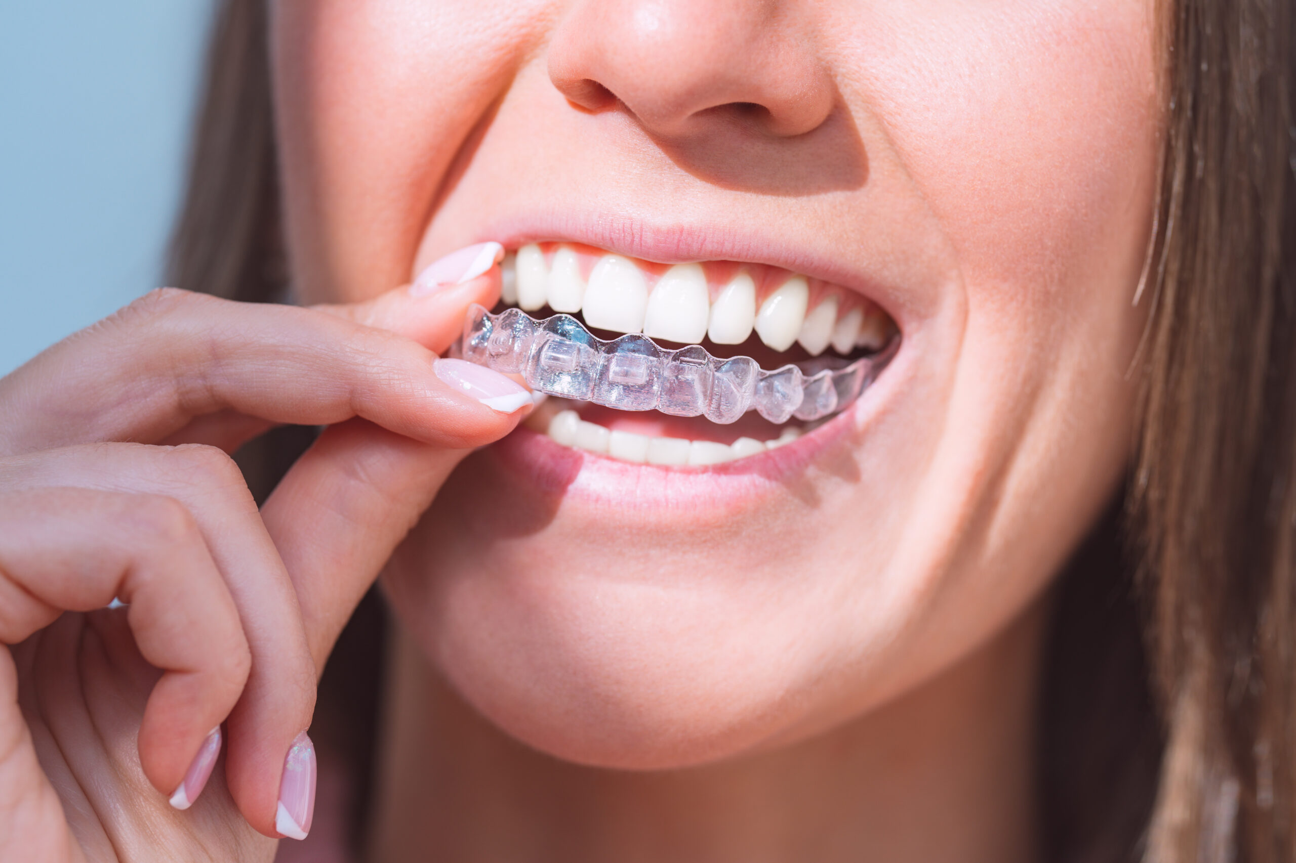 retainers after braces