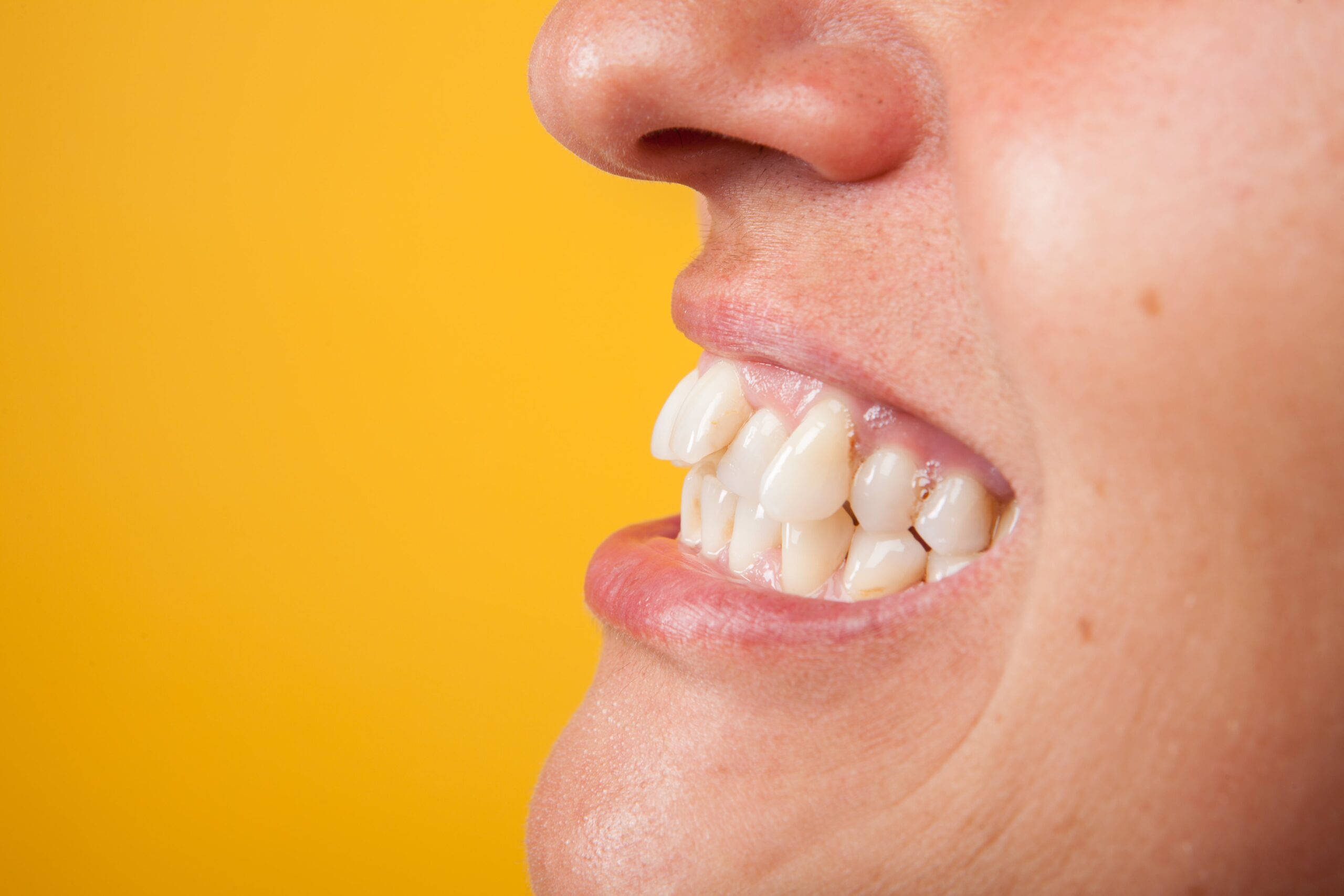 underbite treatment near alpharetta georgia