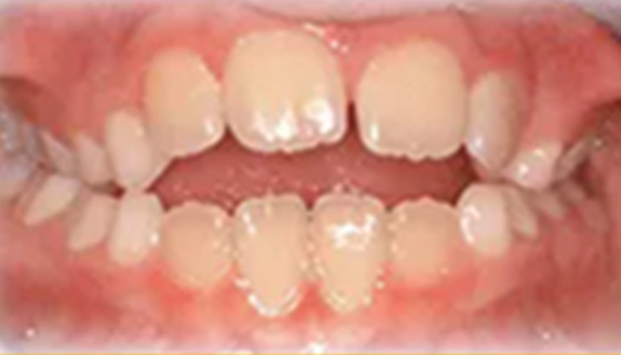 img-newparkorthodontics-treatment-commontreatment-openbite-before
