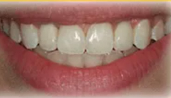img-newparkorthodontics-treatment-missingteeth-after