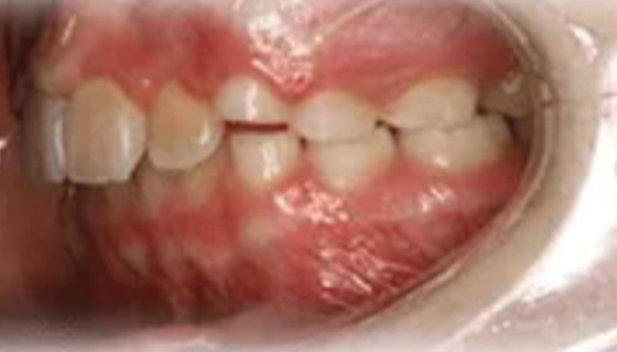 img-newparkorthodontics-treatment-overjet-after