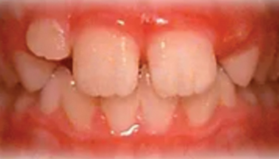 img-newparkorthodontics-treatment-phaseone-before