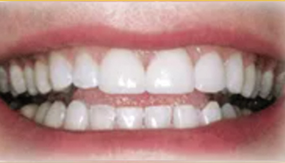 img-newparkorthodontics-treatment-teethspacing-after