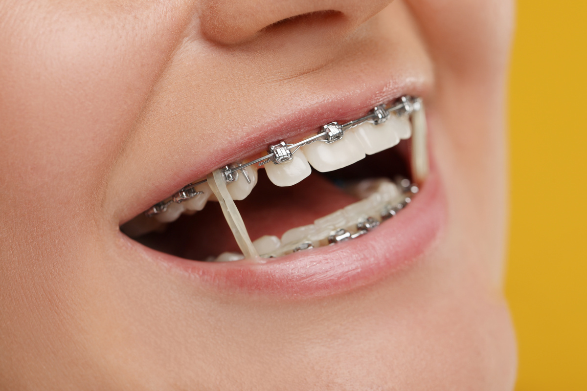 braces treatment near me