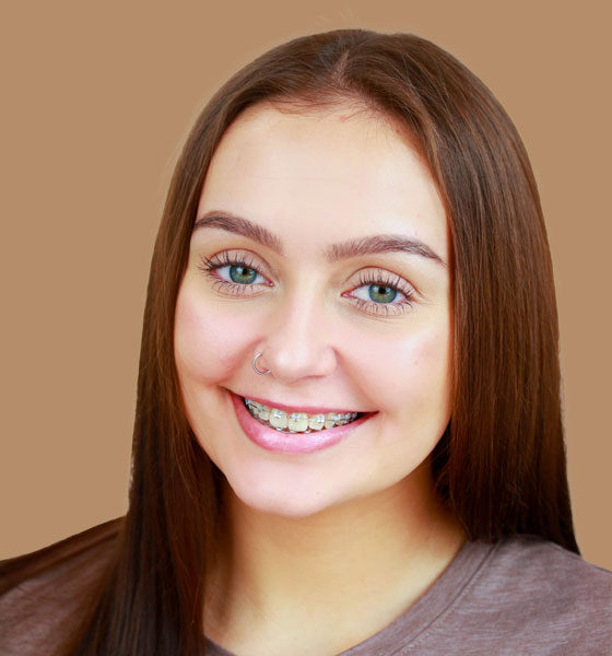 Ceramic Braces
